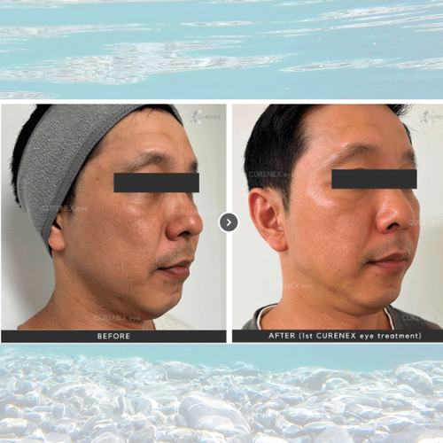Curenex Eye PN treatment before and after results showcasing skin rejuvenation.
