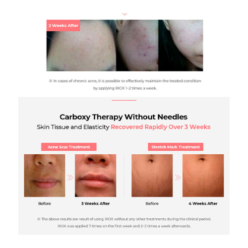 Riox carboxy therapy before and after results for skin treatment, showing significant improvement in acne scars and stretch marks over three weeks.