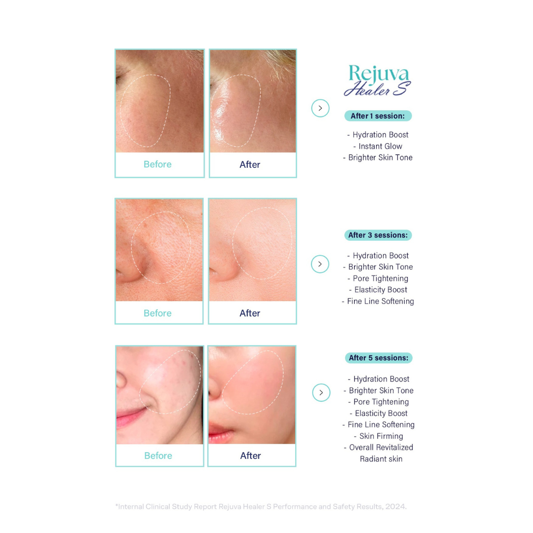 Rejuva Healer S skin booster before and after results showing improved hydration, brighter skin tone, pore tightening, elasticity boost, fine line softening, and skin firming after multiple sessions